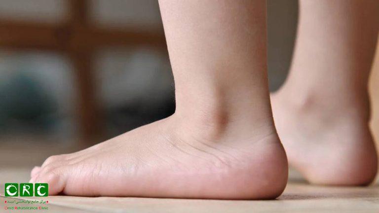 اصلاح کف پای صاف در کودکان و بزرگسالان