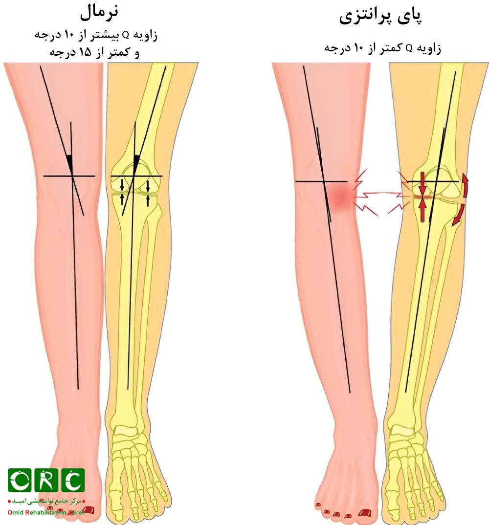 بررسی زاویه Q