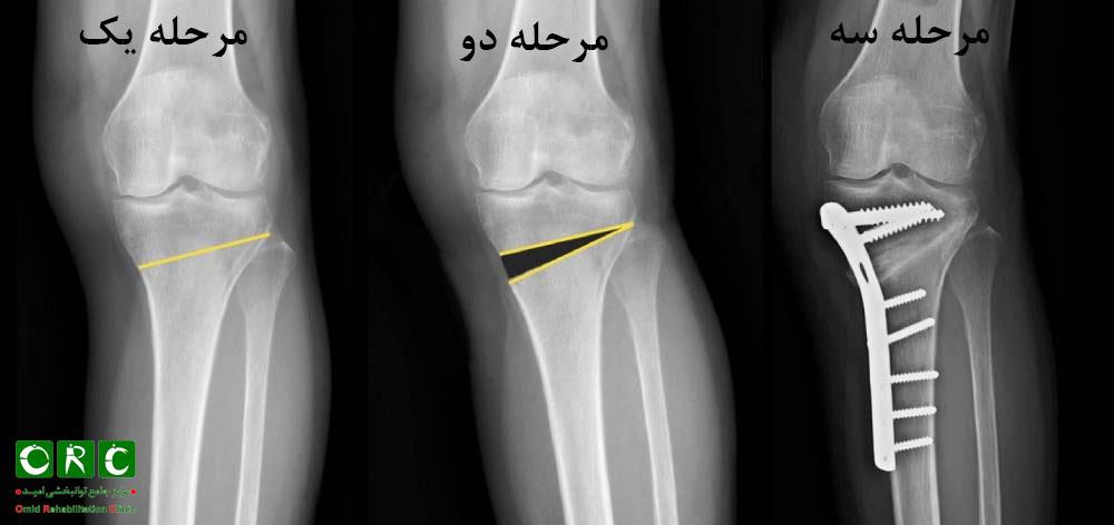 جراحی HTO برای درمان پا پرانتزی