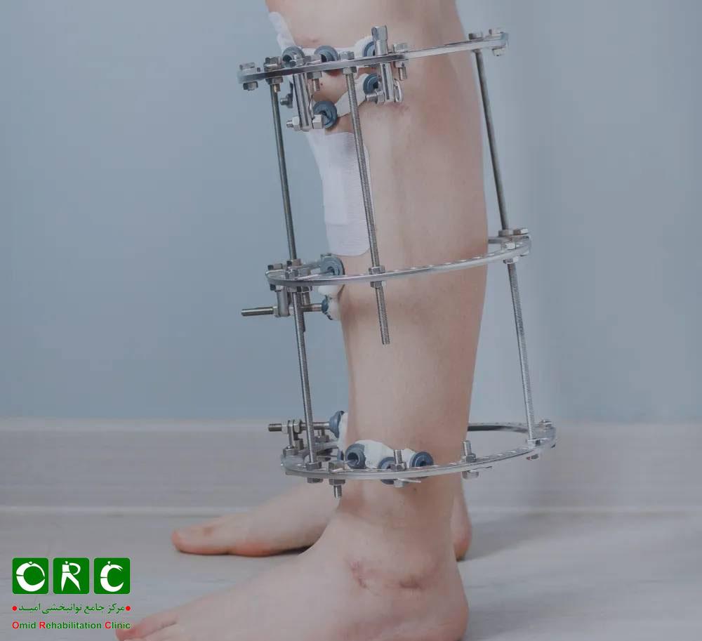 جراحی ثابت‌سازی خارجی یا اکسترنال فیکساتور برای درمان پا پرانتزی