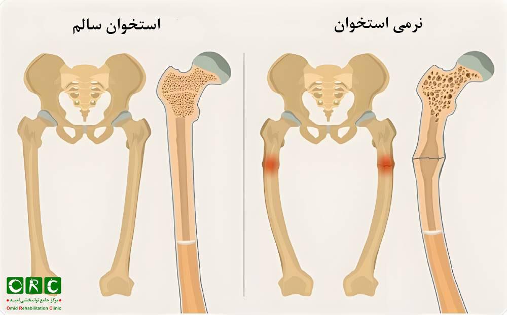 نرمی استخوان یا راشیتیسم