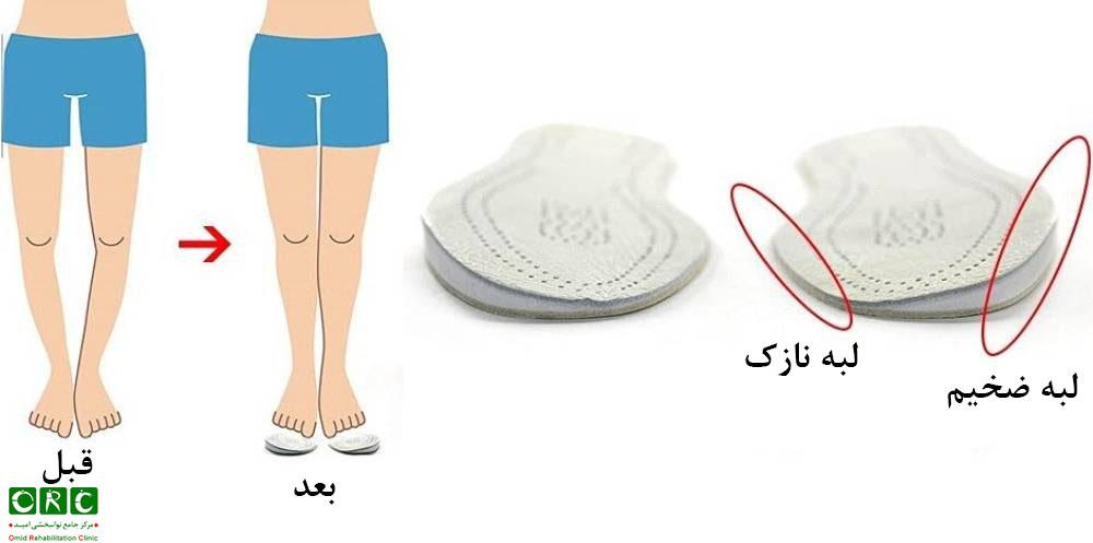 کفی طبی برای درمان پا پرانتزی