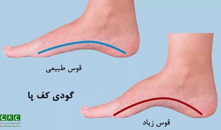 گودی کف پا