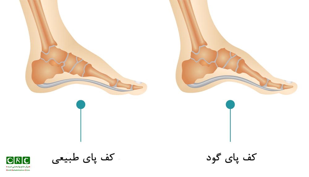قوس کف پا چه زمانی گود محسوب می‌شود