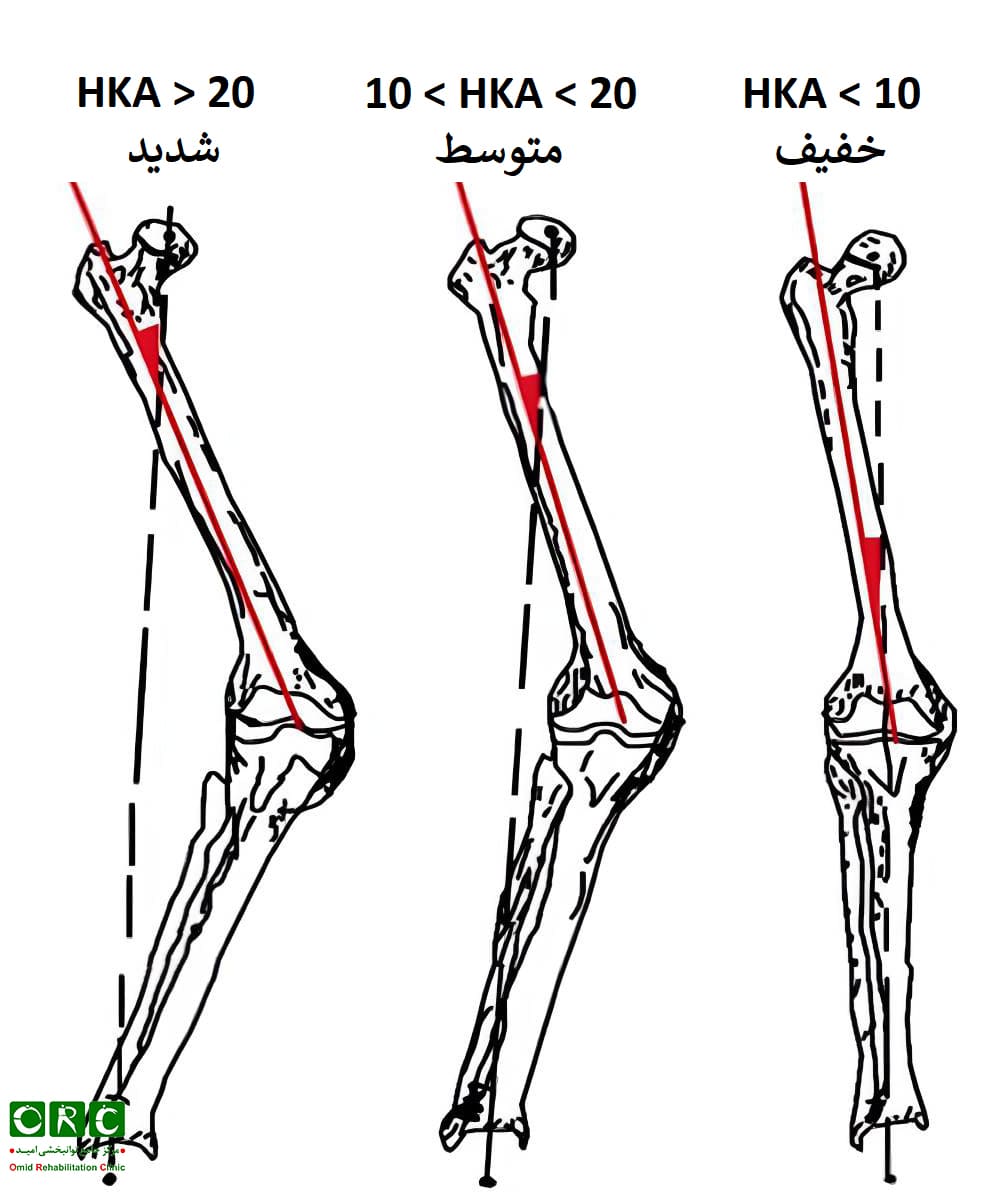 اندازه‌گیری زاویه HKA