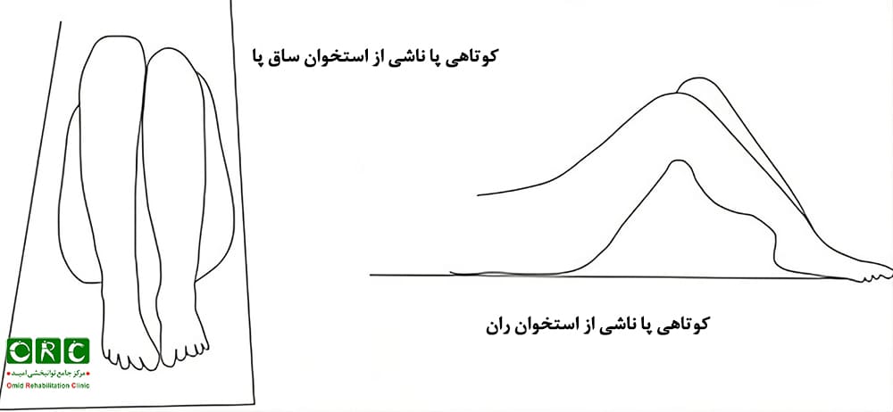 اندازه‌گیری کوتاهی پا در خانه