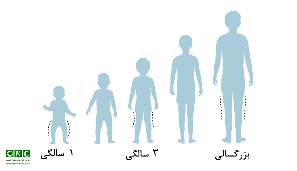 زمان درمان زانو ضربدری