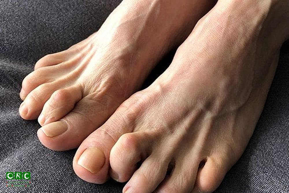 انگشت چنگالی 
