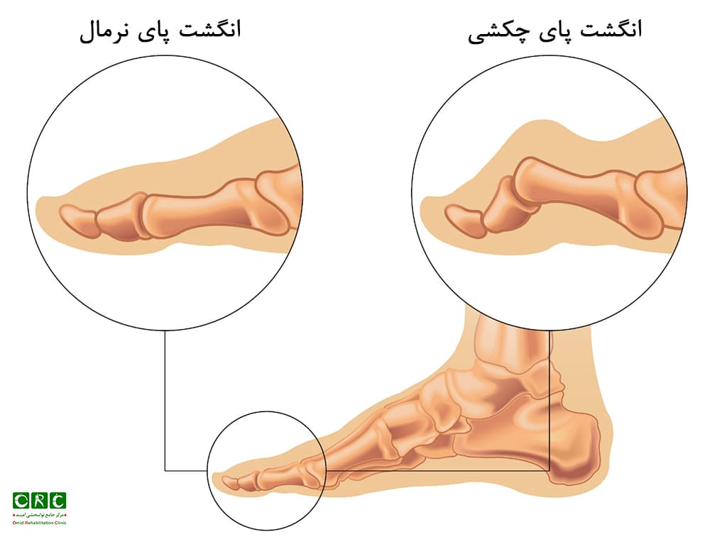 انگشت چکشی 