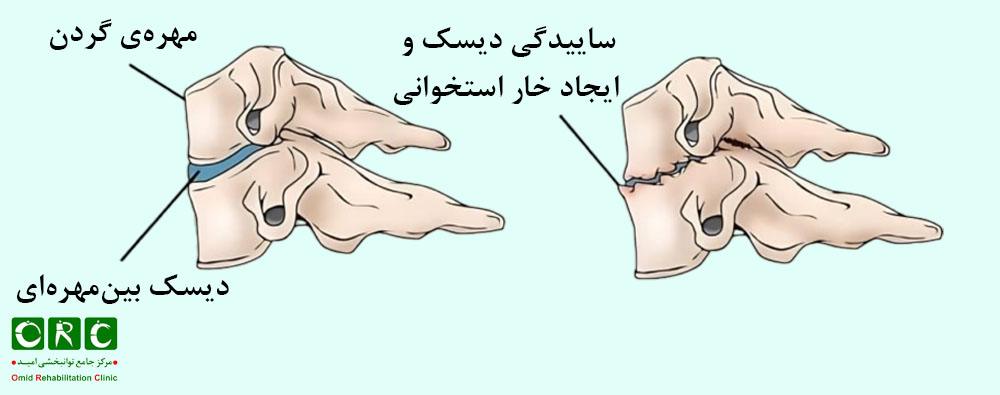 آرتروز گردن