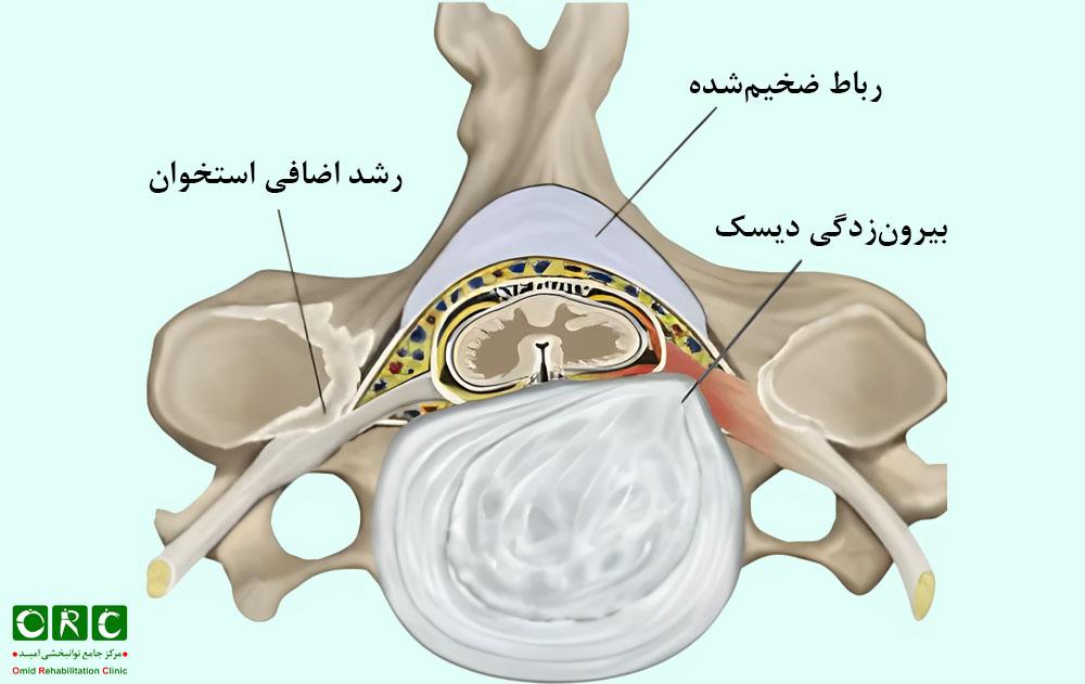 تنگی کانال نخاعی