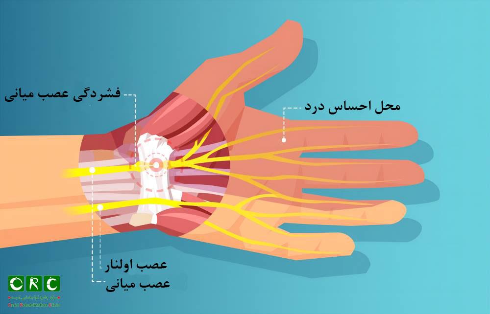 سندروم تونل کارپال