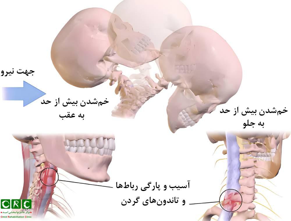 کشیدگی یا رگ به رگ شدن گردن