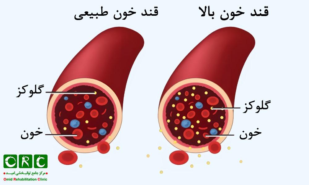 داغی کف پا به دلیل بیماری دیابت