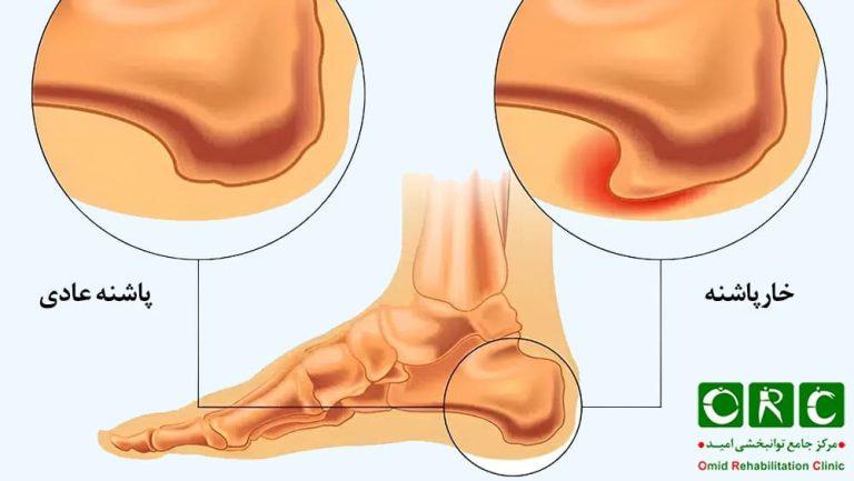 خارپاشنه چیست؟