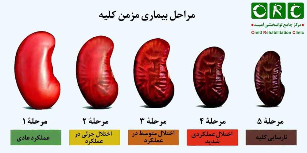 نارسایی کلیوی و احتمال سوزن‌سوزن شدن پا