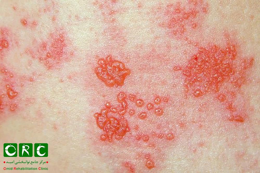 زونا و حمله به سیستم عصبی و در نتیجه بی‌حس پا