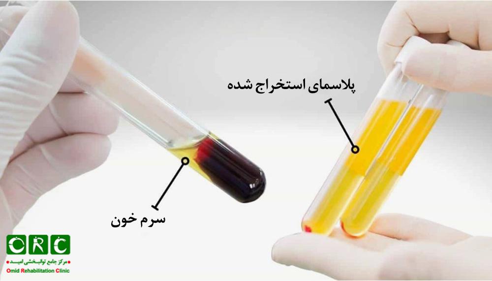 تهیه پلاسمای خون