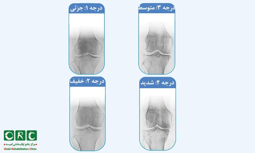 درمان آرتروز زانو