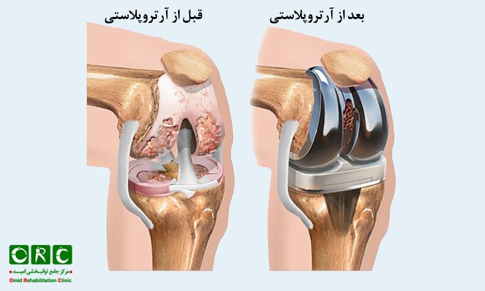 درمان آرتروز پیشرفته