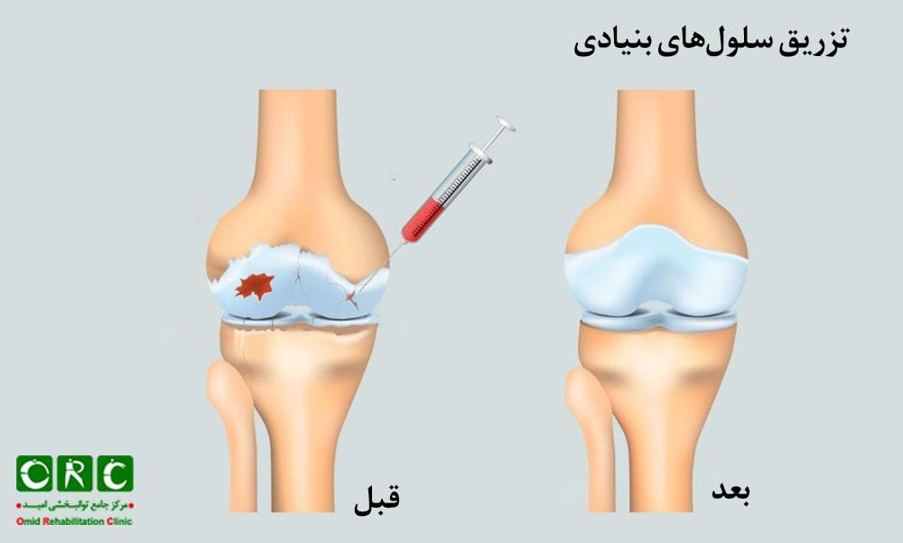 تزریق سلول‌های بنیادی