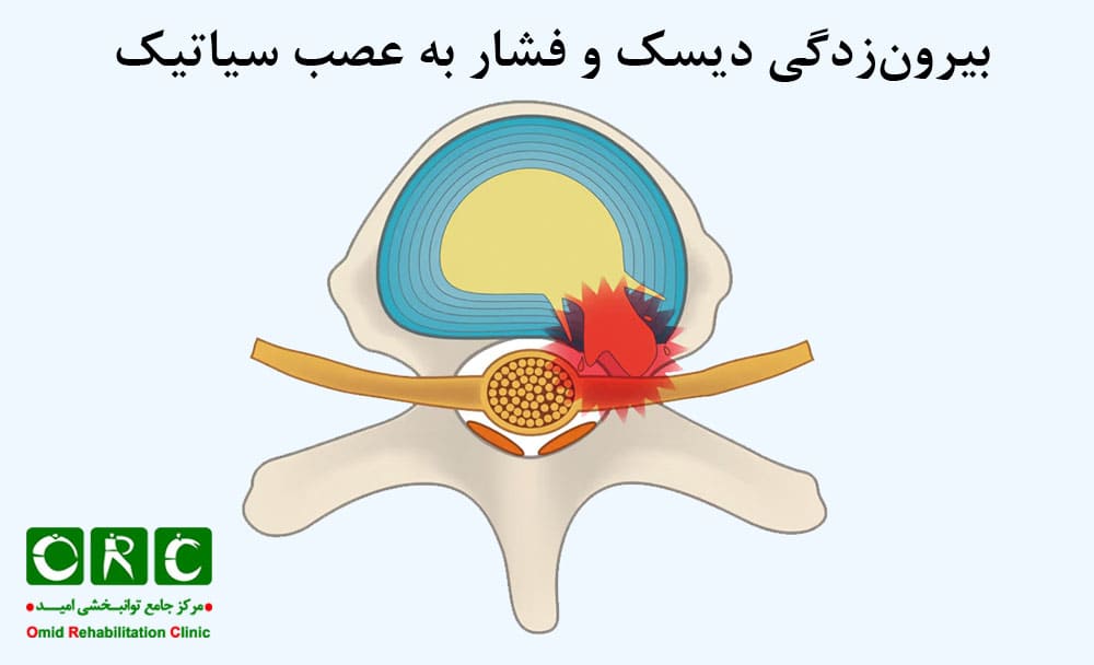 بیرون‌زدگی دیسک و فشار به عصب سیاتیک