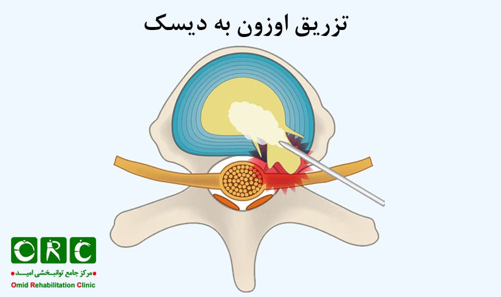 تزریق اوزون به دیسک