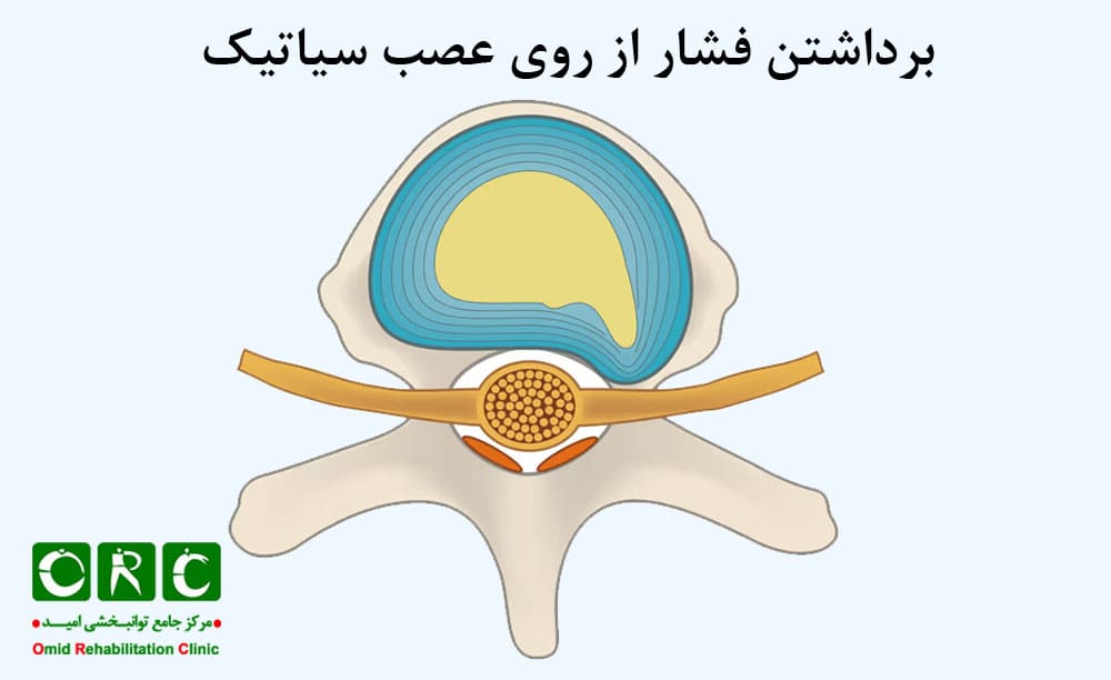 برداشتن فشار از روی عصب سیاتیک