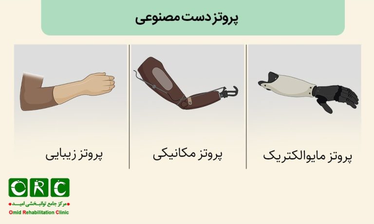 پروتز دست مصنوعی