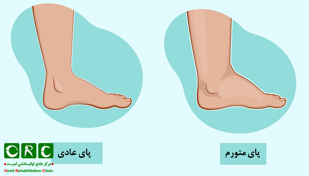 ورم پا