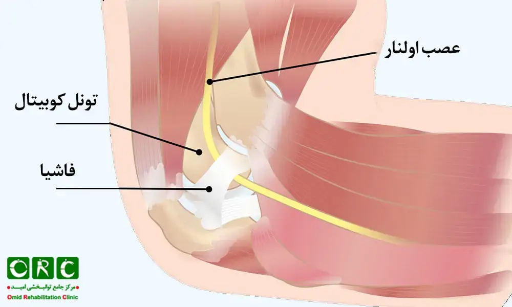 سندرم تونل کوبیتال