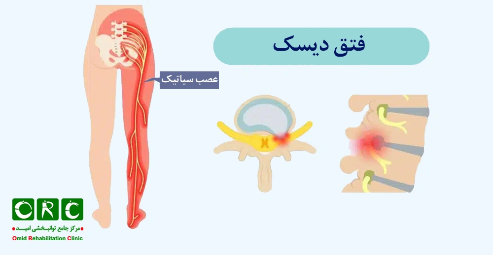 فتق دیسک یا فشار روی عصب‌های نخاعی 