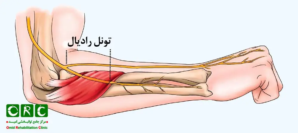 سندرم تونل رادیال