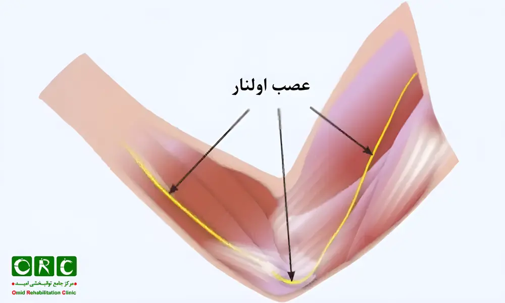 سندرم تونل کوبیتال