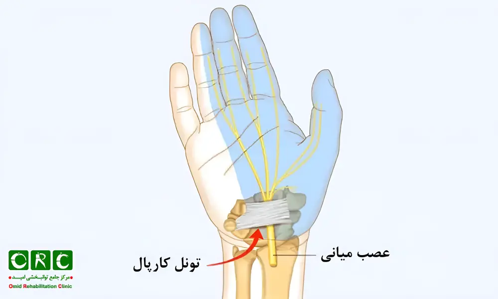 سندرم تونل کارپال