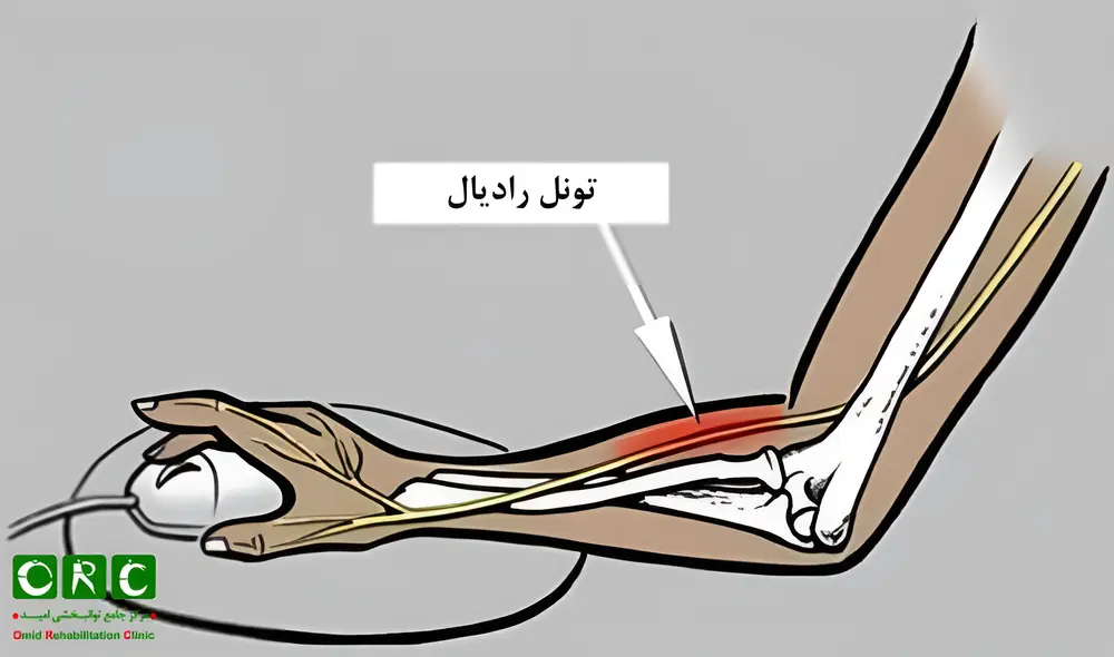 سندرم تونل رادیال